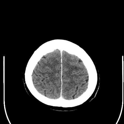 File:Acoustic schwannoma (Radiopaedia 39170-41389 Axial C+ 25).png