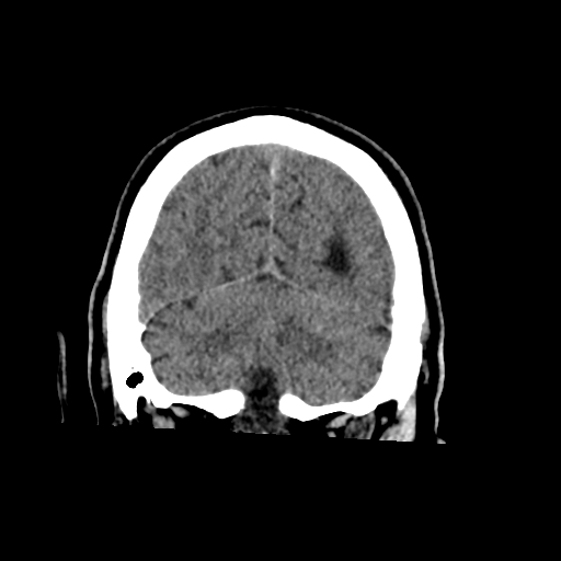 File:Acoustic schwannoma (Radiopaedia 55729-62280 Coronal non-contrast 33).png