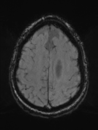 File:Acoustic schwannoma (Radiopaedia 55729-62281 Axial SWI 41).png