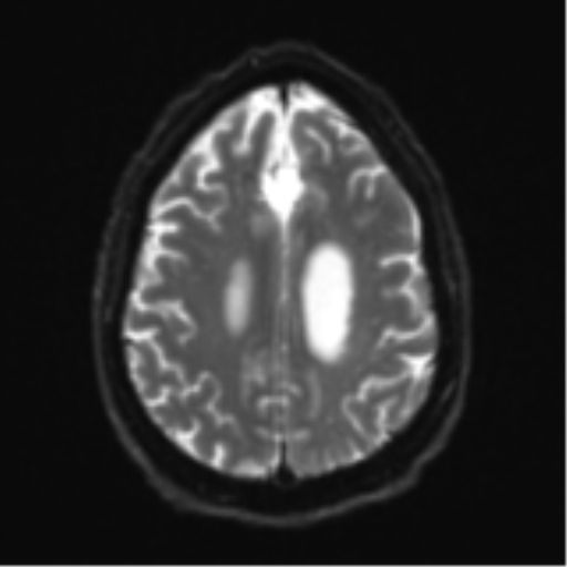 Acoustic schwannoma (Radiopaedia 55729-62281 E 21).png