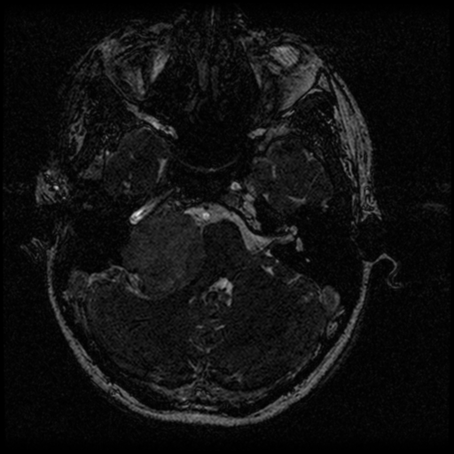 Acoustic schwannoma - eroding petrous apex (Radiopaedia 39674-42004 Axial T2 29).png