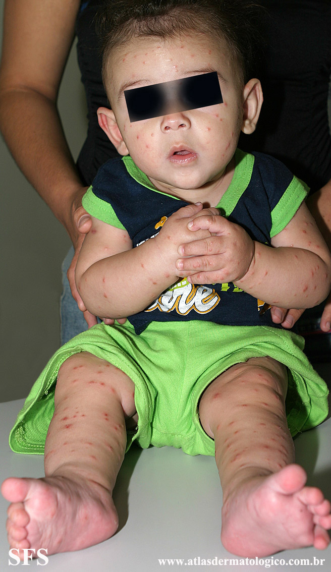 Acrodermatitis Infantile Papular (Dermatology Atlas 34).jpg