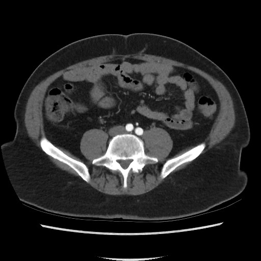 File:Active colonic bleed on CT (Radiopaedia 49765-55025 Axial C+ arterial phase 53).jpg
