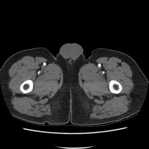 File:Active colonic bleed on CT (Radiopaedia 49765-55025 Axial C+ arterial phase 96).jpg