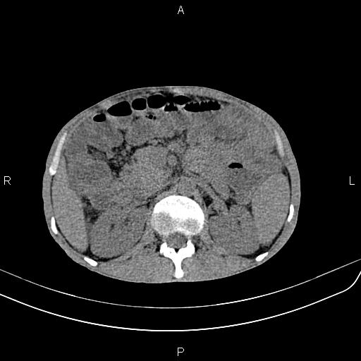 File:Active crohn disease (Radiopaedia 87133-103397 Axial non-contrast 37).jpg