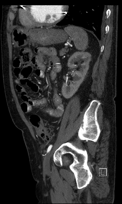 Active lower gastrointestinal bleeding - diverticular (Radiopaedia 61203-69106 Sagittal C+ arterial phase 50).jpg