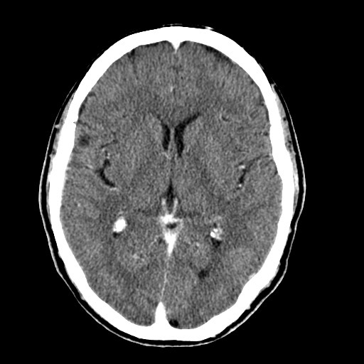 File:Active neurocysticercosis before and after therapy (Radiopaedia 71710-82099 Axial C+ delayed 50).jpg