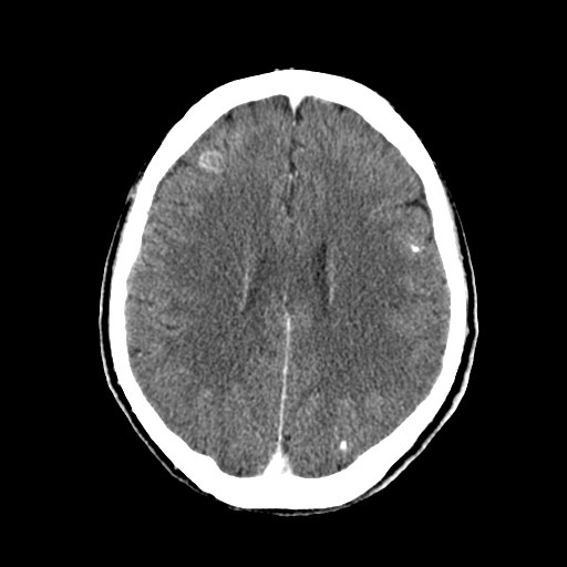 File:Active neurocysticercosis before and after therapy (Radiopaedia 71710-82100 Axial C+ delayed 61).jpg
