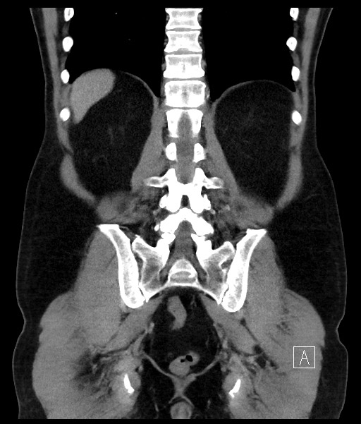 Acute-on-chronic pancreatitis (Radiopaedia 67286-76656 Coronal C+ portal venous phase 57).jpg