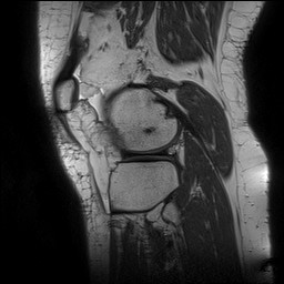 Acute-on-chronic transient lateral patellar dislocation with trochlear dysplasia (Radiopaedia 84099-99349 Sagittal PD 124).jpg
