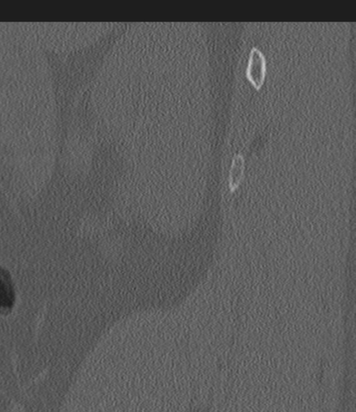 Acute L1 burst compression fracture (Radiopaedia 34430-35755 Sagittal bone window 67).png