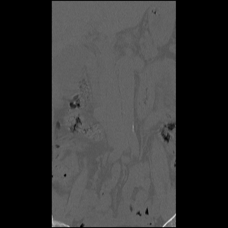 Acute Schmorl's node (Radiopaedia 83276-102365 Coronal bone window 8).jpg