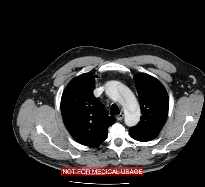 Acute aortic dissection - Stanford type A (Radiopaedia 40661-43285 Axial C+ portal venous phase 2).jpg
