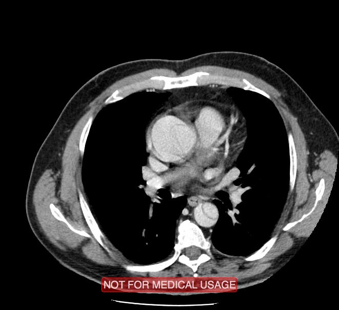 Acute aortic dissection - Stanford type A (Radiopaedia 40661-43285 Axial C+ portal venous phase 25).jpg