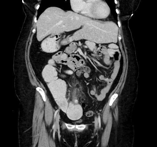 Acute appendicitis, heterotaxy syndrome (Radiopaedia 66884-76202 Coronal C+ portal venous phase 48).jpg