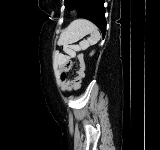 Acute appendicitis, heterotaxy syndrome (Radiopaedia 66884-76202 Sagittal C+ portal venous phase 106).jpg