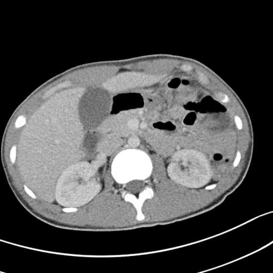 File:Acute appendicitis (Radiopaedia 32614-33572 Axial C+ portal venous phase 22).jpg