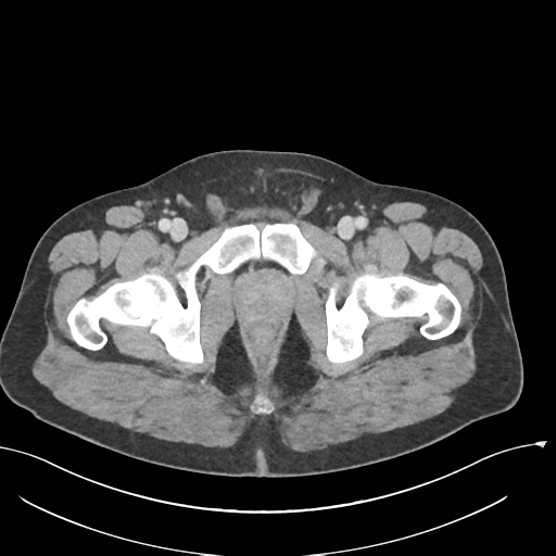 Acute appendicitis (Radiopaedia 36611-38177 Axial C+ portal venous phase 91).png