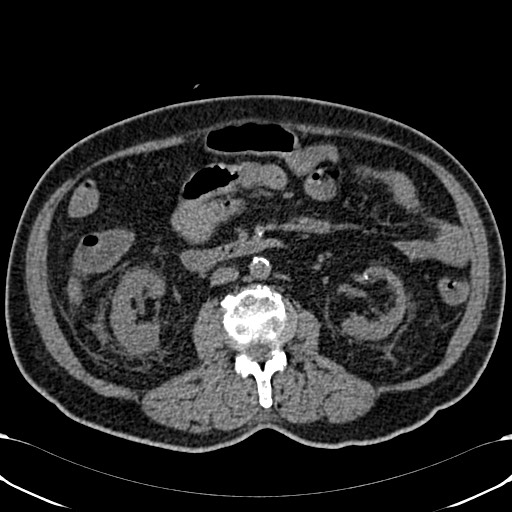Acute appendicitis (Radiopaedia 58627-65818 Axial non-contrast 42).jpg
