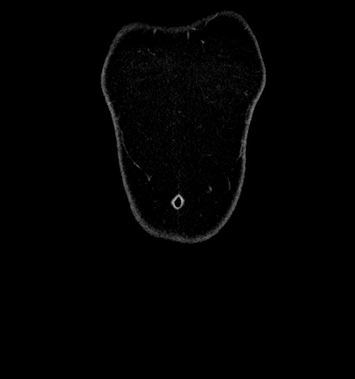 Acute appendicitis (Radiopaedia 77016-88960 Coronal C+ portal venous phase 11).jpg