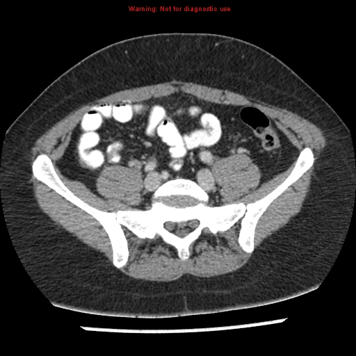 File:Acute appendicitis (Radiopaedia 7966-8812 C+ portal venous phase 36).jpg