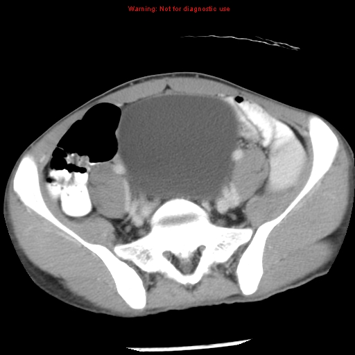 Acute appendicitis (Radiopaedia 8195-9045 Axial C+ portal venous phase 55).jpg