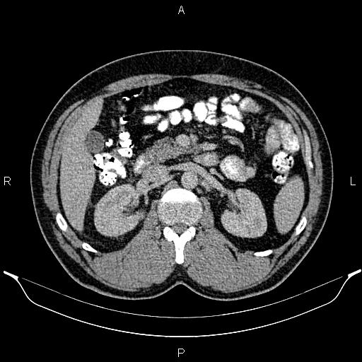 File:Acute appendicitis (Radiopaedia 84780-100240 Axial C+ portal venous phase 41).jpg