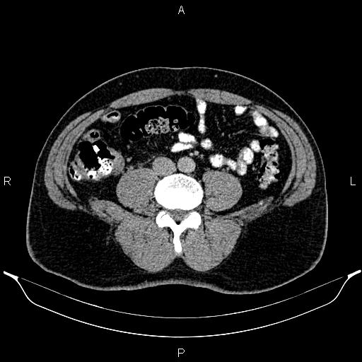 Acute appendicitis (Radiopaedia 84780-100240 Axial C+ portal venous phase 67).jpg