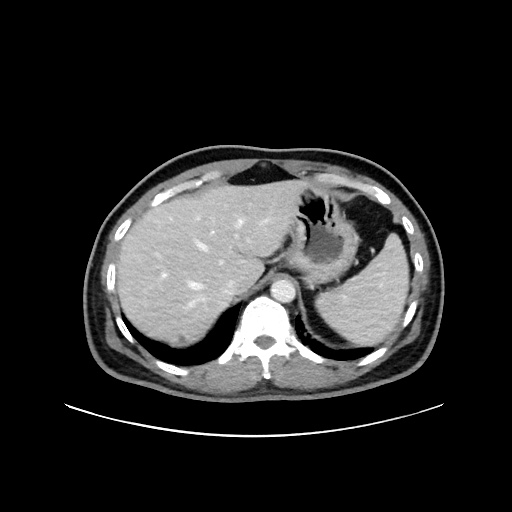 Acute appendicitis and COVID 19 pneumonia (Radiopaedia 76604-88380 Axial C+ portal venous phase 15).jpg