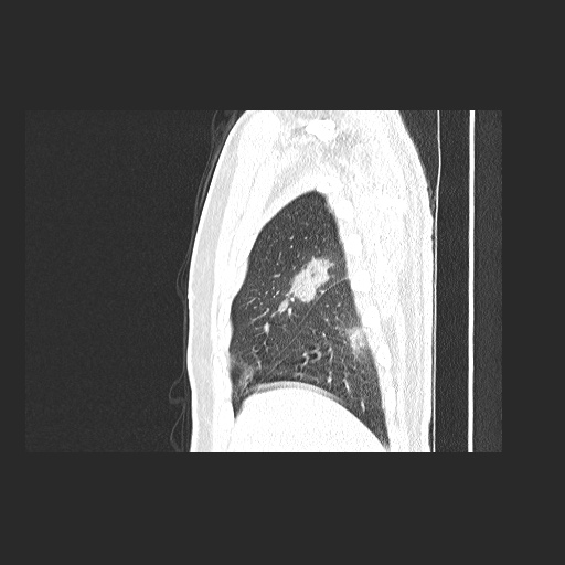 Acute appendicitis and COVID 19 pneumonia (Radiopaedia 76604-88380 Sagittal lung window 17).jpg