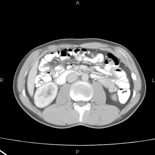 File:Acute appendicitis with CT arrowhead sign (Radiopaedia 21474-21411 Axial C+ portal venous phase 17).jpg