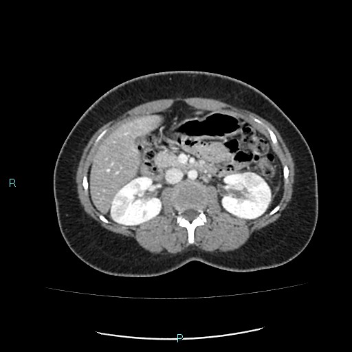 Acute bilateral pyelonephritis (Radiopaedia 37146-38881 Axial C+ portal venous phase 44).jpg