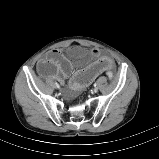Acute bowel ischemia (Radiopaedia 87695-104114 Axial C+ portal venous phase 67).jpg