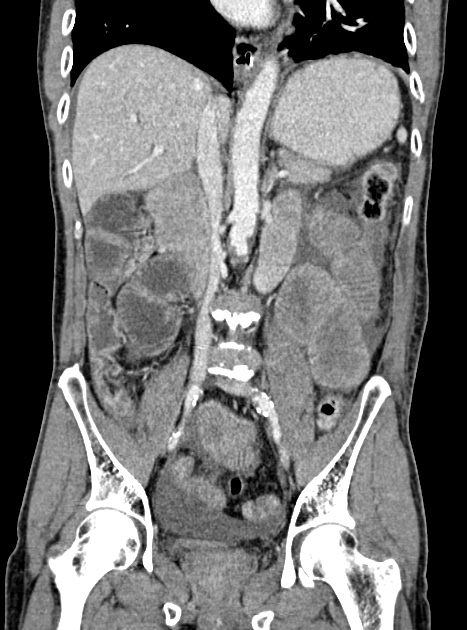 Acute bowel ischemia (Radiopaedia 87695-104114 Coronal C+ portal venous phase 216).jpg