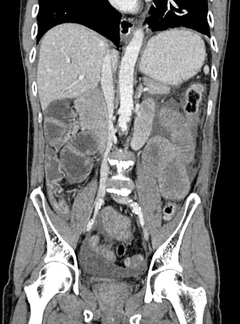 Acute bowel ischemia (Radiopaedia 87695-104114 Coronal C+ portal venous phase 217).jpg