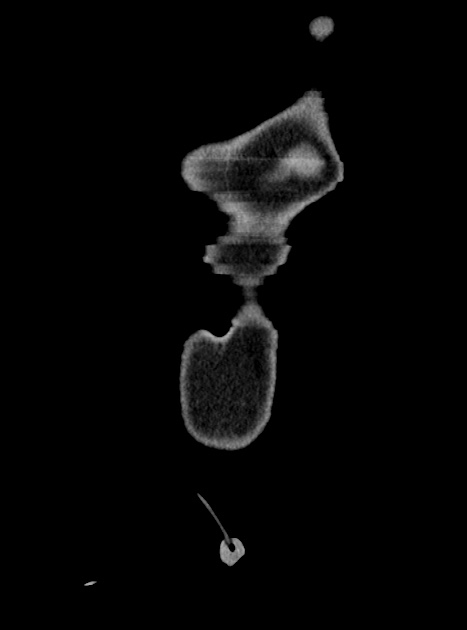 Acute bowel ischemia (Radiopaedia 87695-104114 Coronal C+ portal venous phase 52).jpg