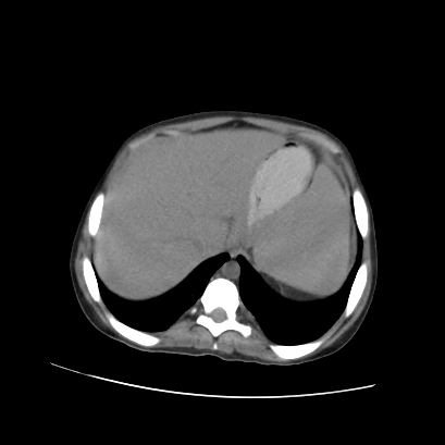 File:Acute calculous cholecystitis in patient with osteopetrosis (Radiopaedia 77871-90159 Axial non-contrast 19).jpg