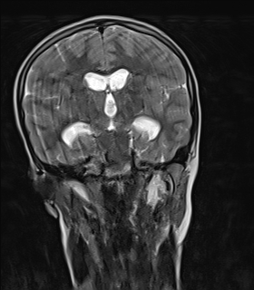 File:Acute cerebellar ataxia (Radiopaedia 61487-69446 Coronal T2 7).jpg