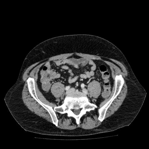 File:Acute cholecystitis and incidental left sided IVC (Radiopaedia 49352-54459 Axial C+ portal venous phase 108).jpg