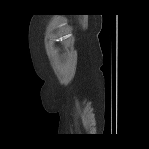 Acute cholecystitis with tensile fundus sign (Radiopaedia 71394-81723 Sagittal non-contrast 151).jpg