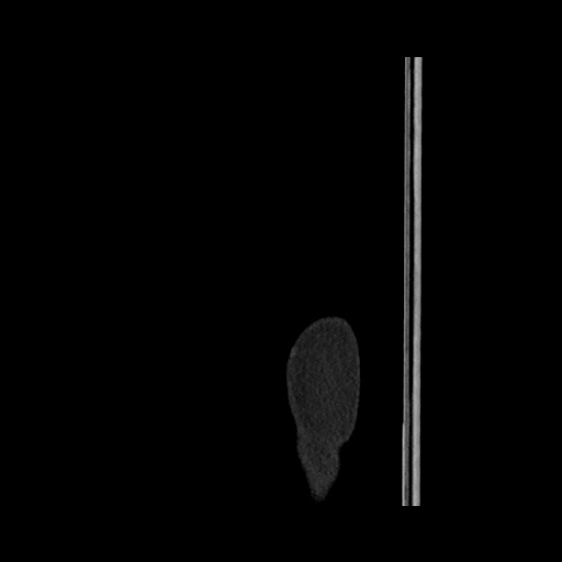 File:Acute cholecystitis with tensile fundus sign (Radiopaedia 71394-81723 Sagittal non-contrast 5).jpg