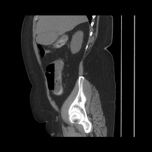 Acute cholecystitis with tensile fundus sign (Radiopaedia 71394-81723 Sagittal non-contrast 58).jpg