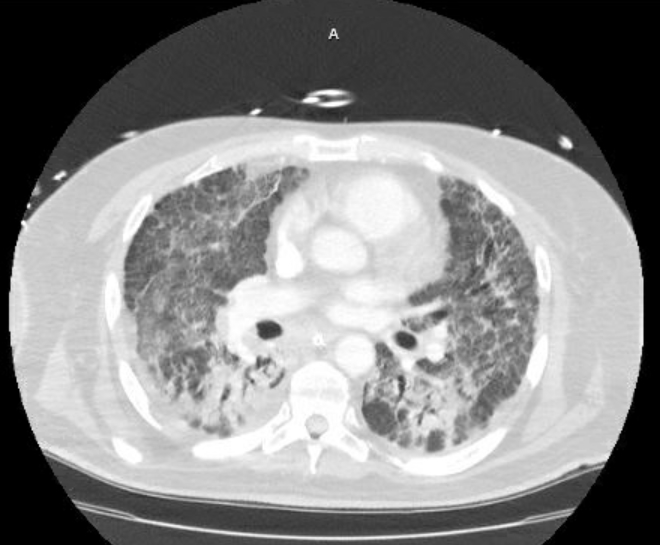 File:Acute cor pulmonale (ultrasound) (Radiopaedia 83508-98818 Axial 2).jpg
