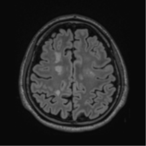 Acute disseminated encephalomyelitis (ADEM)- Anti-NMDA receptor encephalitis (Radiopaedia 54920-61201 Axial FLAIR 50).png