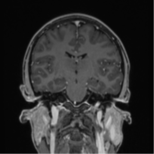 Acute disseminated encephalomyelitis (ADEM) (Radiopaedia 65319-74349 Coronal T1 C+ 23).png