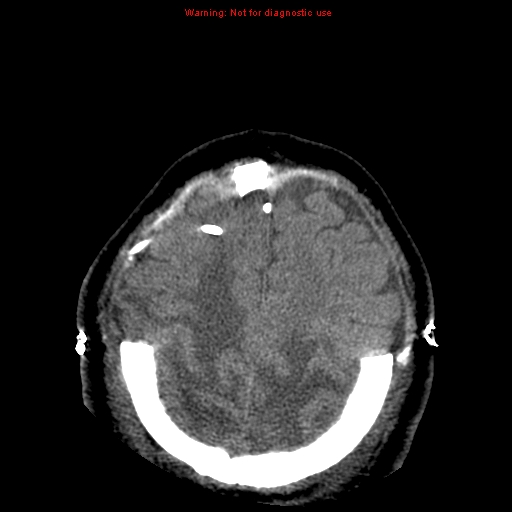 Acute hemorrhagic leukoencephalitis (Radiopaedia 14076-43697 Axial non-contrast 41).jpg