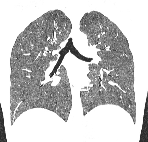 Acute hypersensitivity pneumonitis (Radiopaedia 85293-100870 Coronal lung window 76).jpg