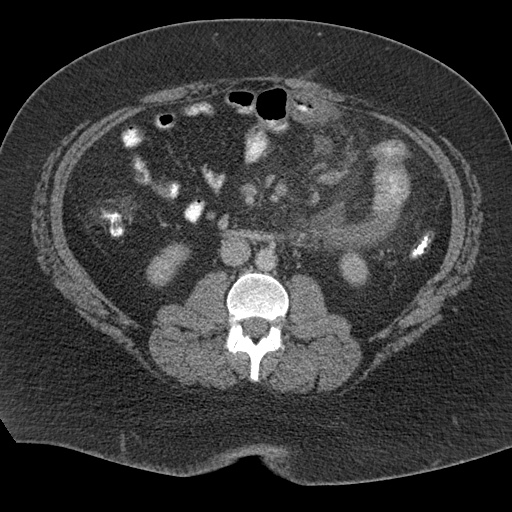Acute mesenteric venous ischemia (Radiopaedia 46041-50383 Axial C+ portal venous phase 62).jpg