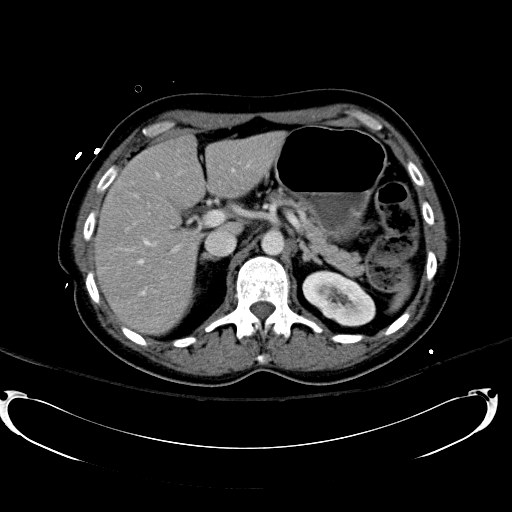 File:Acute myocardial infarction in CT (Radiopaedia 39947-42415 Axial C+ portal venous phase 38).jpg