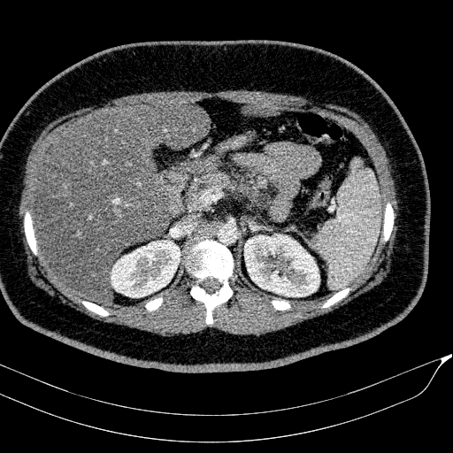 Acute on chronic pancreatitis (Radiopaedia 80902-94423 Axial C+ portal venous phase 54).jpg